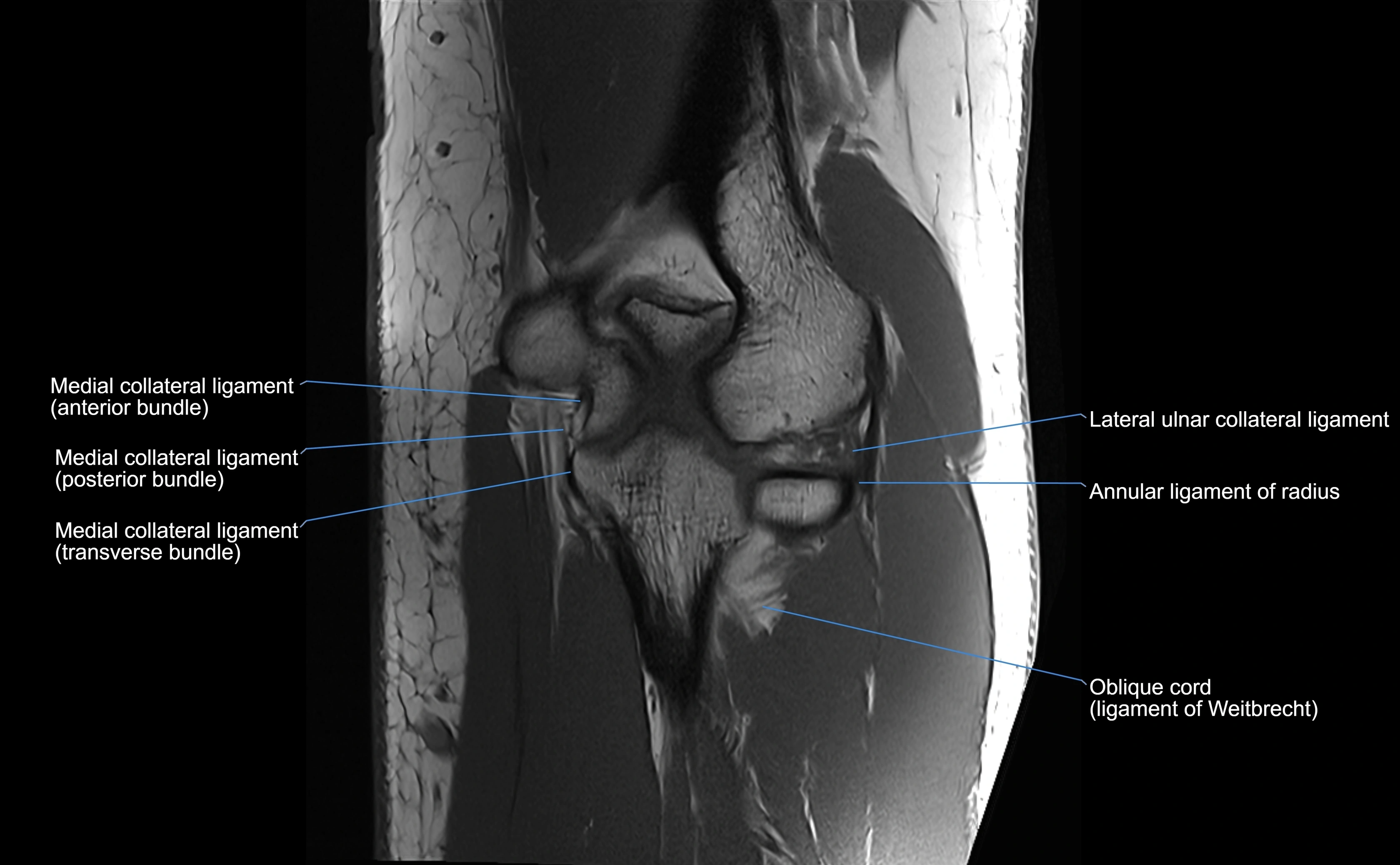 MRI elbow ligaments coronal cross sectional anatomy 3T  radiology  image-img-07001-00023.webp
